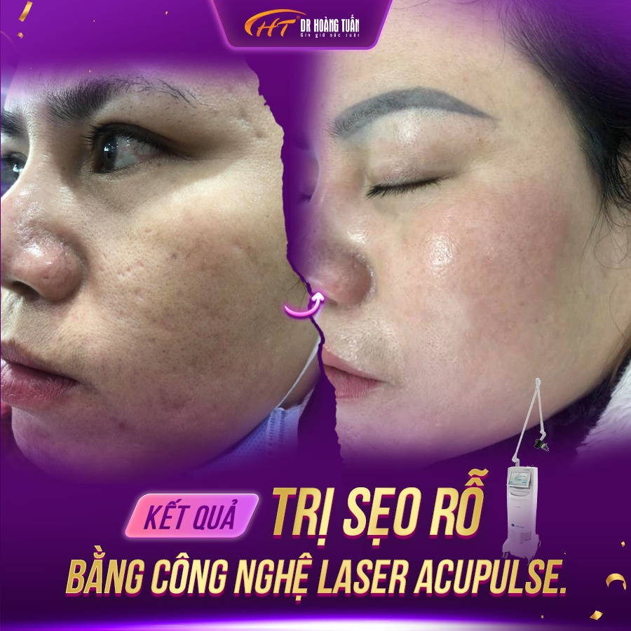 điều trị sẹo rỗ ở đâu tốt nhất